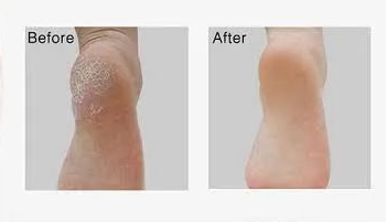 Portable Vacuum Foot Grinder - Electric Callus Remover